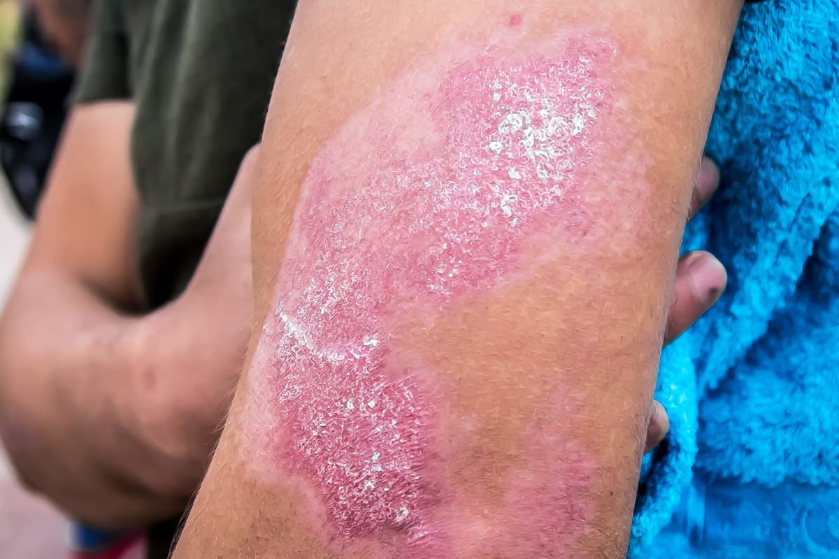 Florida burn injury lawyer, man with burns on his arm