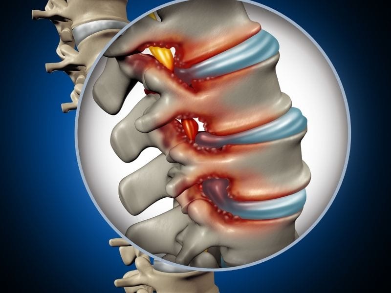 Spinal Stenosis Back injury