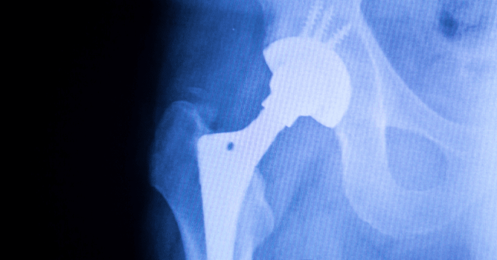 hip implant